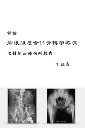 評論：攝護腺癌合併骨轉移疼痛之針刺治療病例報告