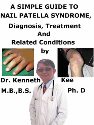 A Simple Guide to Nail Patella Syndrome, Diagnosis, Treatment and Related Conditions【電子書籍】..