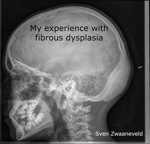 My experience with fibrous dysplasia