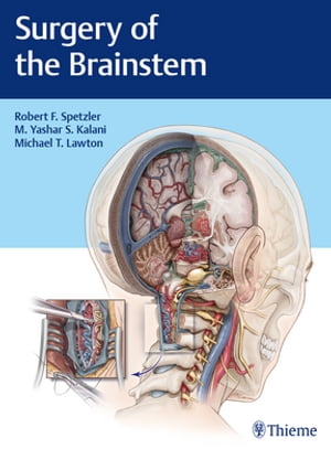 Surgery of the Brainstem