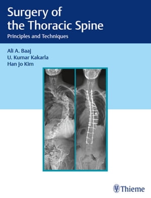 Surgery of the Thoracic Spine