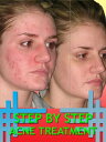 Step By Step Acne Treatment【電子書籍】[ A