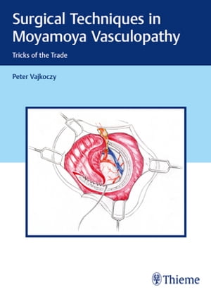 Surgical Techniques in Moyamoya Vasculopathy Tricks of the Trade【電子書籍】[ Peter Vajkoczy ]