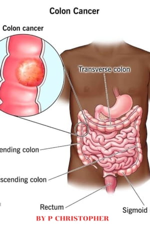 Colon cancer disease