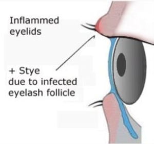 Blepharitis: Causes, Symptoms and Treatments