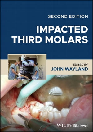 Impacted Third Molars