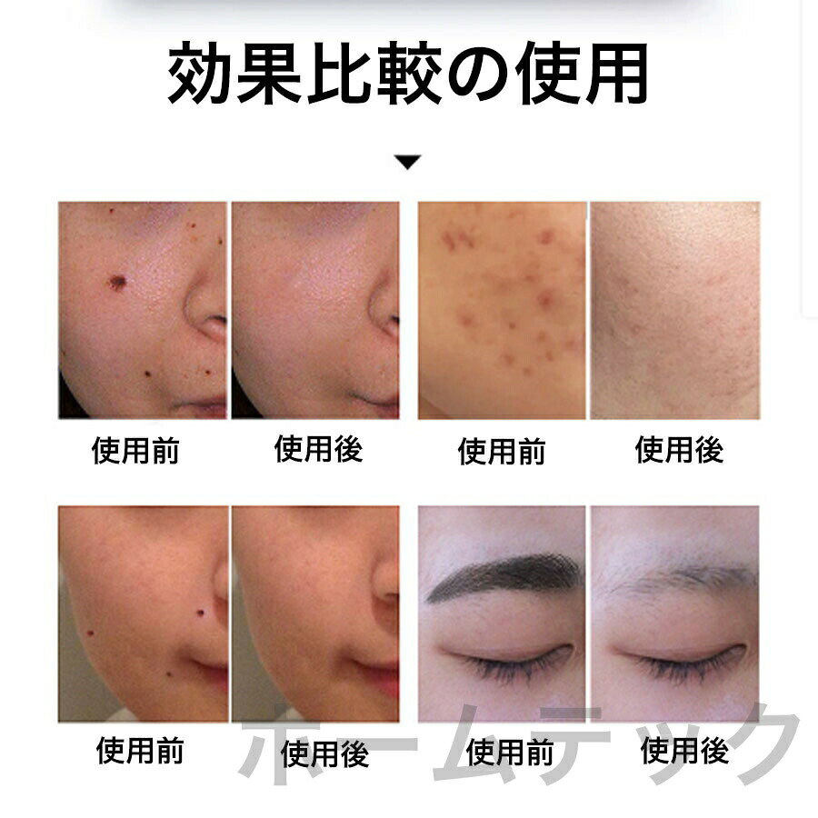 ピコレーザー 美顔器 美容機器 自宅 家庭用 レーザーペン シミ取り ほくろそばかす除去 シミ 斑 青色レーザー 赤色レーザー レーザー そばかす ピコ秒レーザー 2025 プレゼント 母の日
