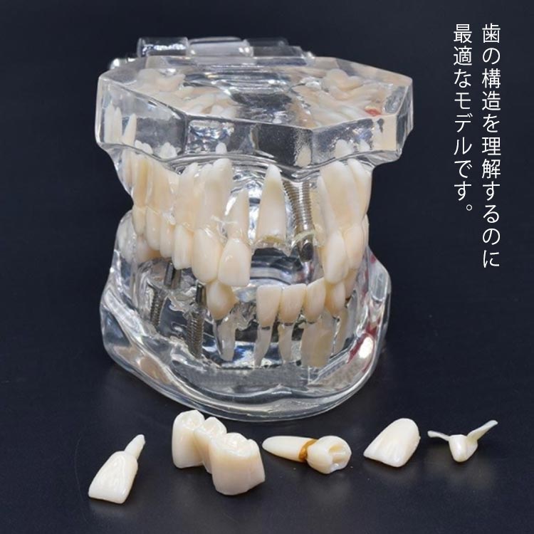 透明 開閉式 歯の模型 歯模型 疾患展示模型 モデル 用 歯医者 人体解剖モデル 歯科 歯模型 歯 差し歯 歯 置物 口腔内模型 歯科模型 クリニック 歯根 学習 説明 教材 人体模型 研究 インテリア 歯列模型 標本 実験 医療 図鑑 医学 解剖 勉強