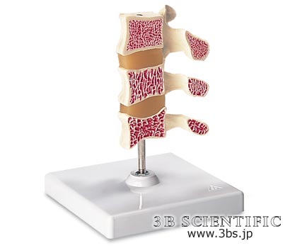世界基準 3Bサイエンフィティック社骨粗鬆症モデル、3段型 人体模型