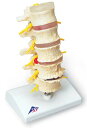 【送料無料】【無料健康相談 対象製品】3B社　病理学模型　椎間板ヘルニアと変形性脊椎症モデル　（a795) 人体模型