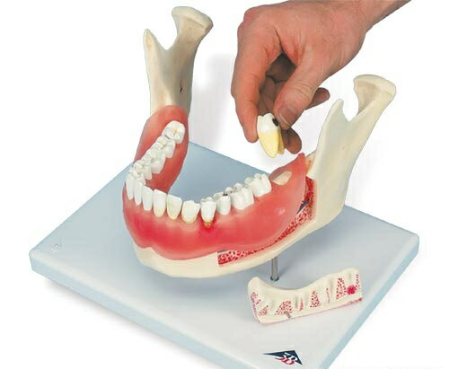 【送料無料】【無料健康相談 対象製品】3B社　歯・口腔模型 歯と歯茎の疾患モデル (d26) 人体模型