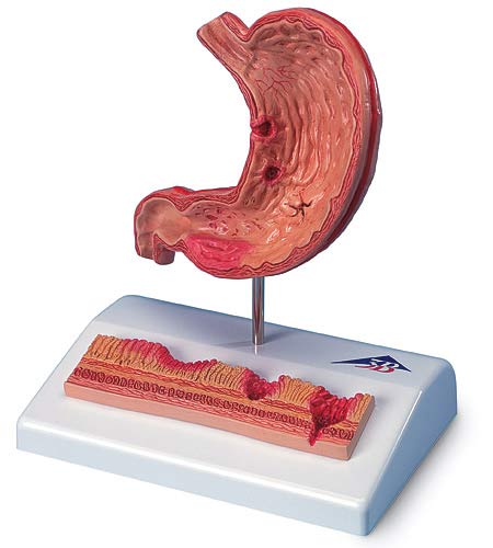 【送料無料】3B社　病理学模型　胃潰瘍モデル　(k17） 人体模型