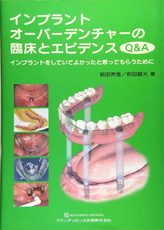 楽天市場】インプラントオーバーデンチャーの通販