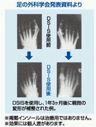 SORBO(ソルボ) DSISソルボ外反母趾対策 ハーフインソールタイプ ベージュ Mサイズ(250.〜26.0cm)