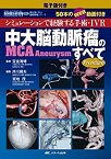 【中古】 中大脳動脈瘤 (MCA Aneurysm) のすべて