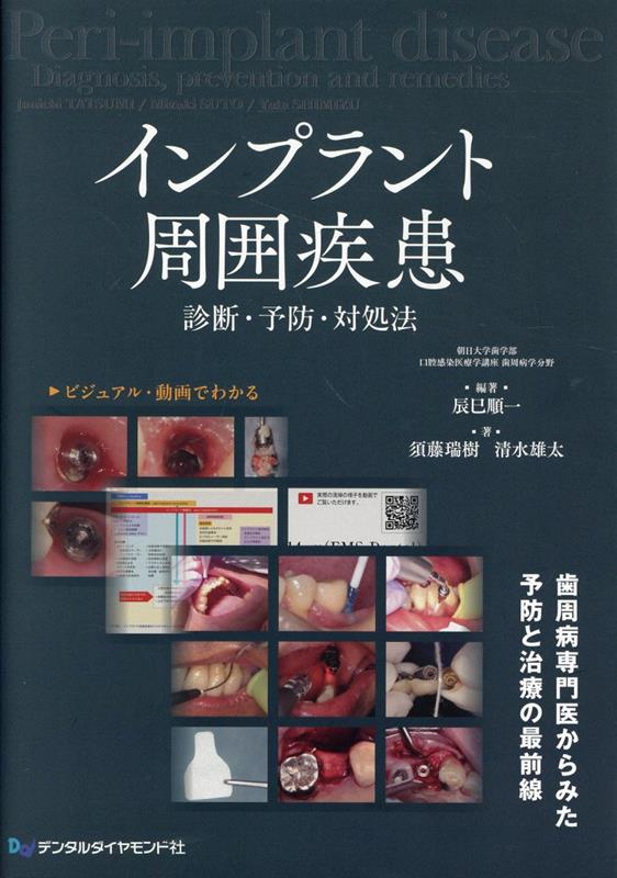 【中古】インプラント周囲疾患　診断・予防・対処法（大型本）