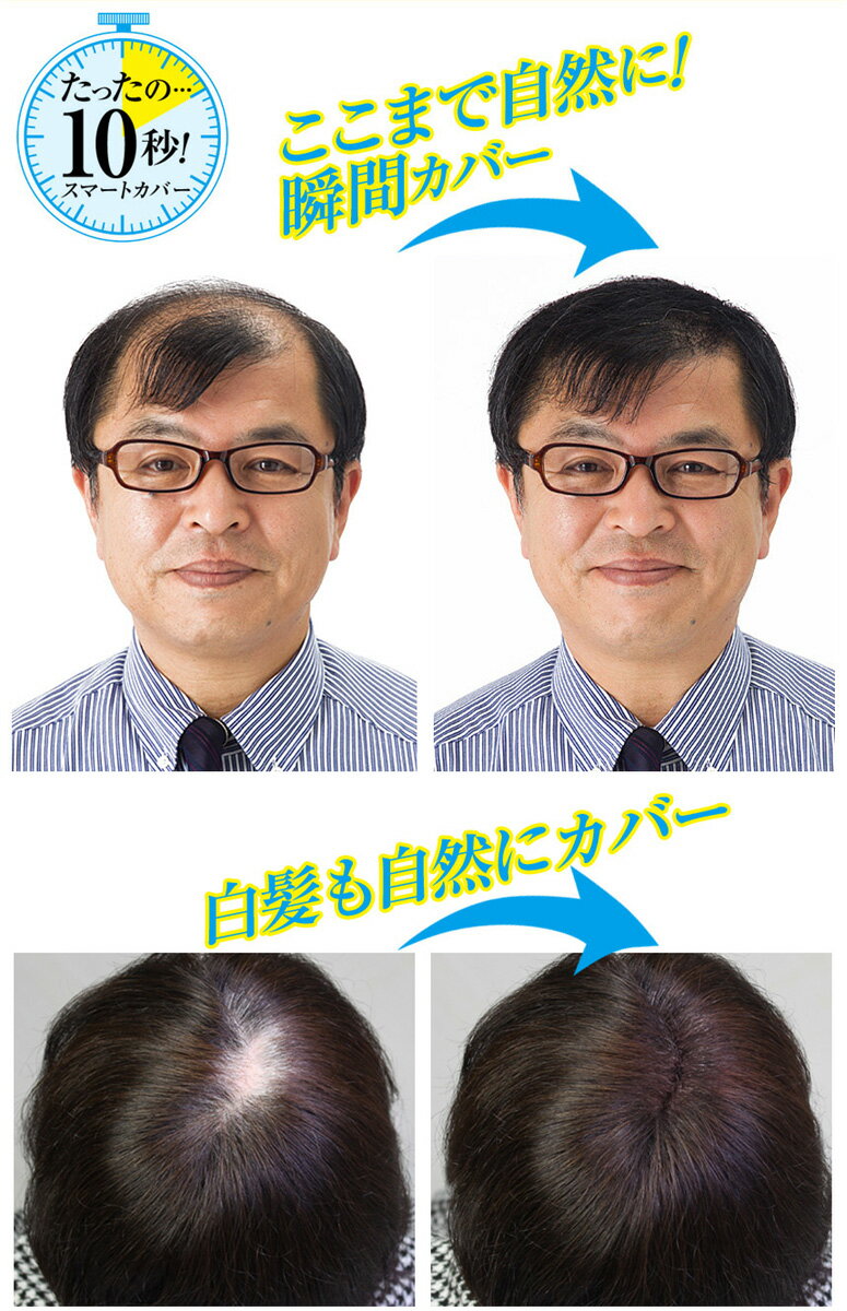 29歳でハゲてしまった同士達へ。若ハゲの ...