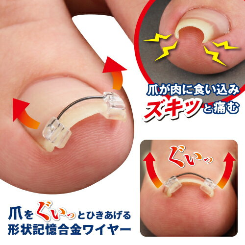 ■ポスト投函■巻き爪ワイヤーガード